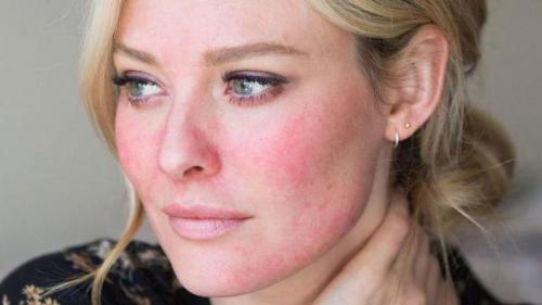 Крем ивермектин при розацеа. Солантра (крем): отзывы, инструкция, цена, состав, аналоги