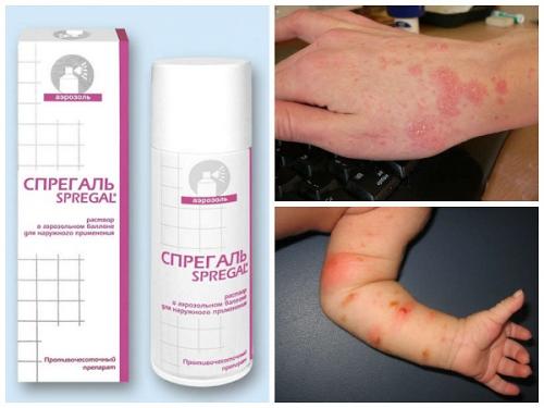 Ивермектин от чесотки. Препараты от чесотки 02