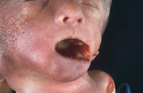 18 я хромосома человека. Антенатальная диагностика