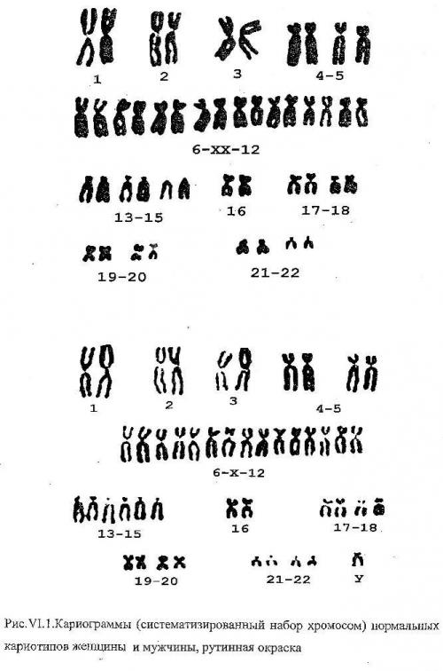 Х хромосома человека. Синдром Дауна кариотип 47 хромосом. Кариотип больного синдром Орбели. Кариограмма синдрома Дауна. Кариотип человека с синдромом Дауна.
