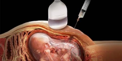 47 хромосом. Диагностика