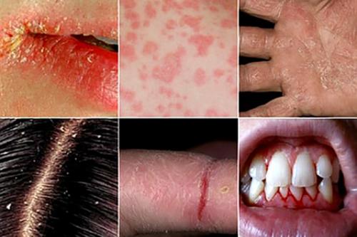 5 фактов о витаминах. 5 фактов об авитаминозе