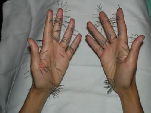 Акупунктурный массаж рук и расположение точек на ладонях. Нахождение точек на ладони 03