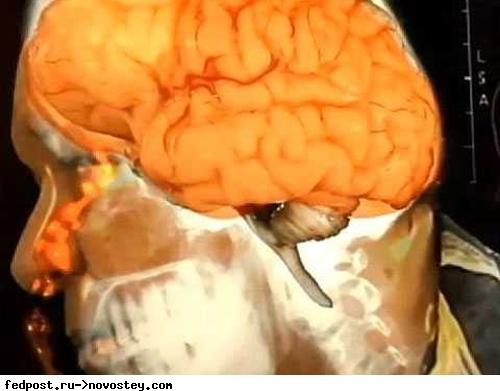 Как высморкать мозг. Американец полтора года высмаркивал мозг, но тот всё не кончался, и не кончался...