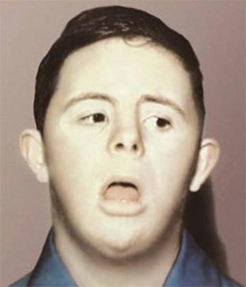 15 хромосомы человека болезни. Хромосомная мутация у человека: виды, причины возникновения, хромосомные болезни