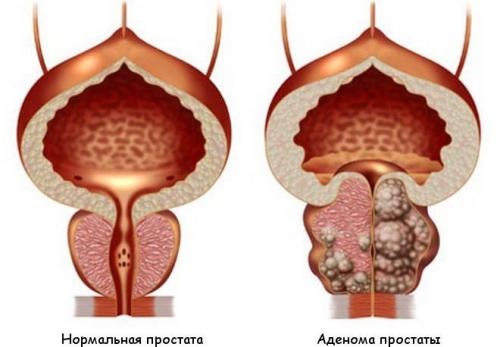 Повышенный тестостерон у мужчин плюсы. Последствия гормонального дисбаланса
