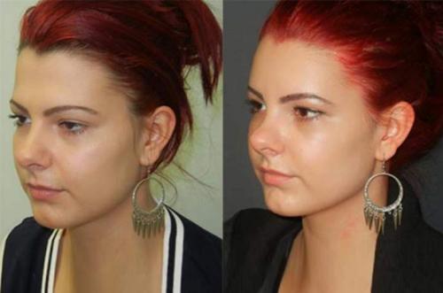 Как сделать лоб более выпуклым. Как избавиться от выпирающих надбровных дуг? Фронтопластика – пластическая операция, способная кардинально преобразить внешность +Видео