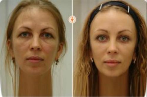 Как сделать лоб более выпуклым. Как избавиться от выпирающих надбровных дуг? Фронтопластика – пластическая операция, способная кардинально преобразить внешность +Видео