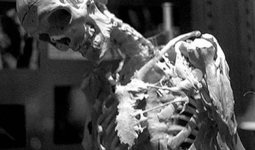 Аномалии человеческого тела. 10 страшных и удивительных аномалий, которые преследуют человека (10 фото)