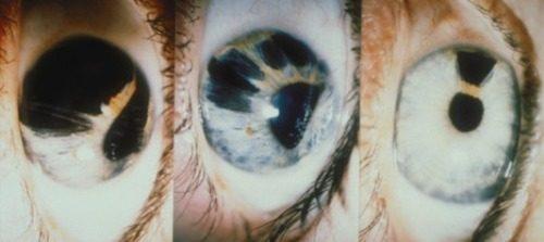 В одном глазу два зрачка. Двойной зрачок: миф или реальность?