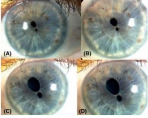 В одном глазу два зрачка. Двойной зрачок: миф или реальность?