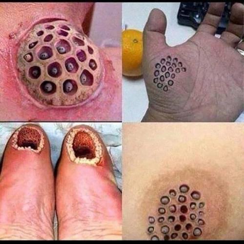 Что такое трипофобия. Если вам сложно досмотреть это до конца, возможно, вы страдаете трипофобией