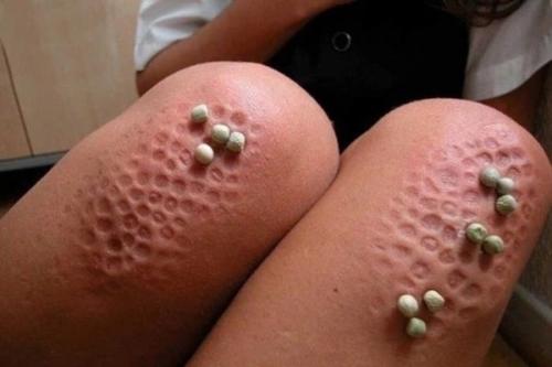 Что такое трипофобия. Если вам сложно досмотреть это до конца, возможно, вы страдаете трипофобией