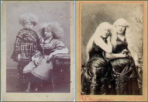 Певица альбинос. Альбиносы