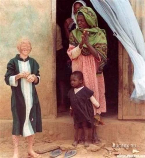 Певица альбинос. Альбиносы