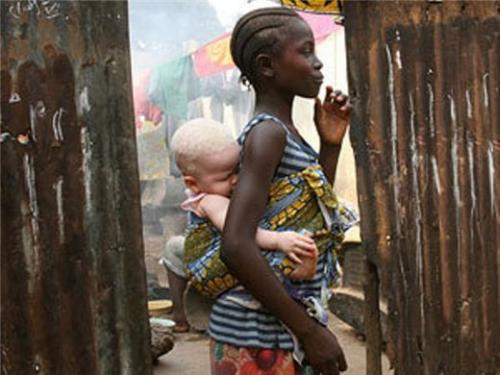 Певица альбинос. Альбиносы