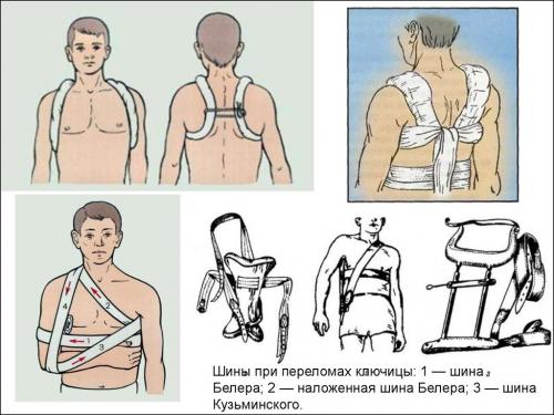 Что следует сделать для оказания первой помощи пострадавшему при переломе ключицы. Неотложная доврачебная помощь при переломе ключицы