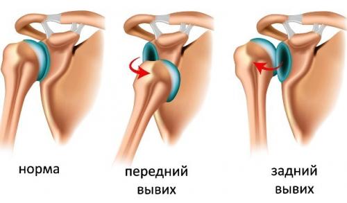 Что следует сделать пострадавшему при вывихе. Что делать при вывихе: первая помощь, симптомы, как лечить