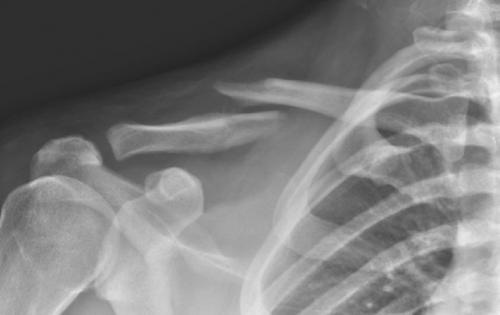 Что следует сделать для оказания первой помощи пострадавшему при переломе ключицы. Неотложная доврачебная помощь при переломе ключицы