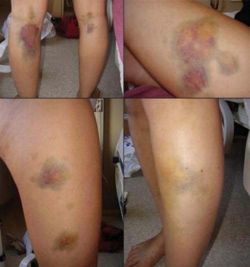 Лономия. Гусеница рода лономия или гусеница «ленивый клоун» (лат. Lonomia Obliqua)