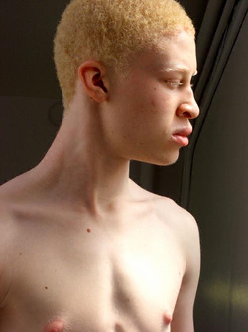 Albino Nipples