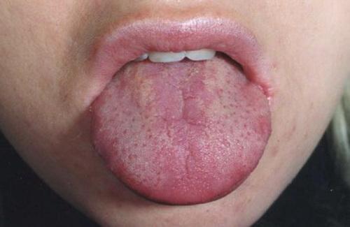 Болезни языка в картинках. Симптомы