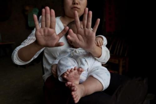 Лишняя часть тела. 12 людей с лишними частями тела (фото)