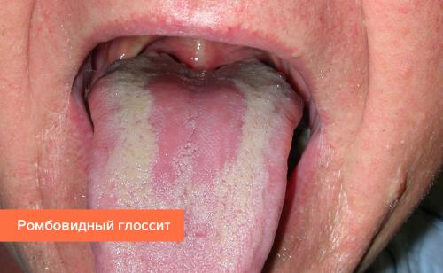 Болезни языка в картинках. Симптомы