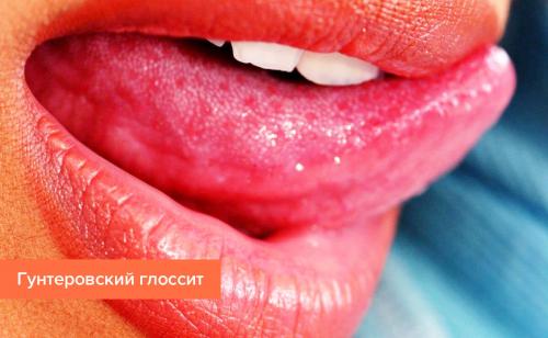 Болезни языка в картинках. Симптомы