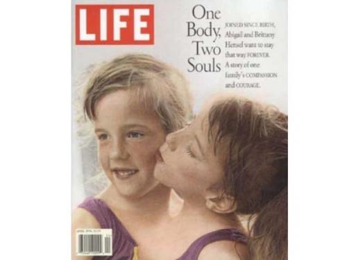 Как сиамские близнецы занимаются любовью. Интересные факты о сиамских близняшках Хенсел