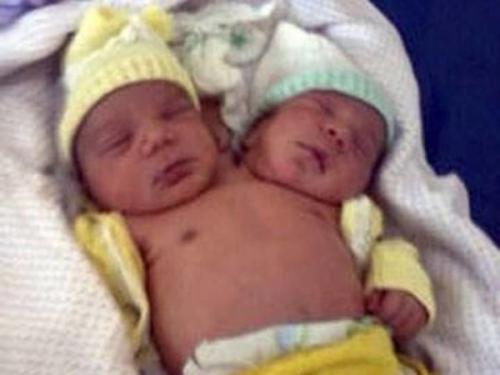 Как сиамские близнецы занимаются любовью. Интересные факты о сиамских близняшках Хенсел