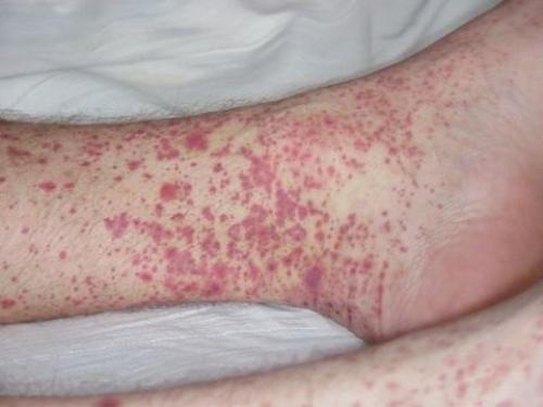 Понижены тромбоциты в крови. Общие сведения 01