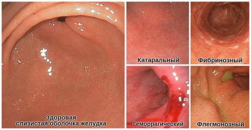 Боль и тяжесть в левом подреберье. Боль в левом подреберье 01