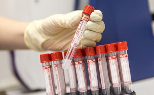 Как умирают от асцита. При каких заболеваниях жидкость начинает накапливаться в брюшной полости?