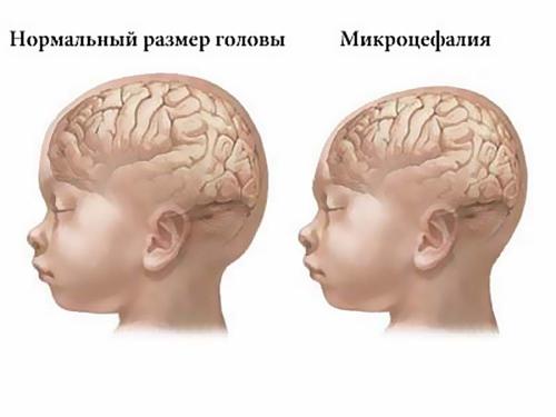 Атавизмы примеры. Примеры атавизмов у человека с фото, атавизмы у животных