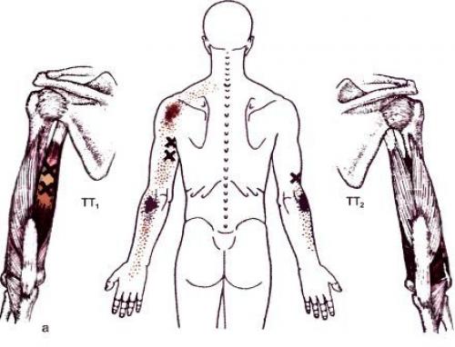 Точки на теле человека. Триггерные точки плеча и руки 12