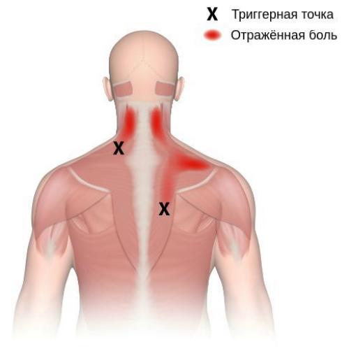 Точки на теле человека. Триггерные точки плеча и руки 18