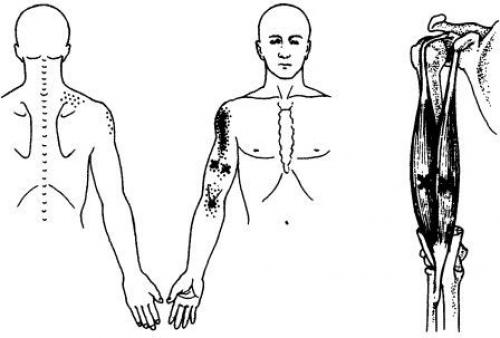 Точки на теле человека. Триггерные точки плеча и руки 11
