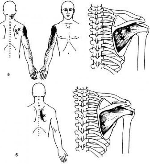 Точки на теле человека. Триггерные точки плеча и руки 01