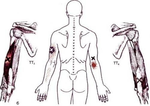 Точки на теле человека. Триггерные точки плеча и руки 13