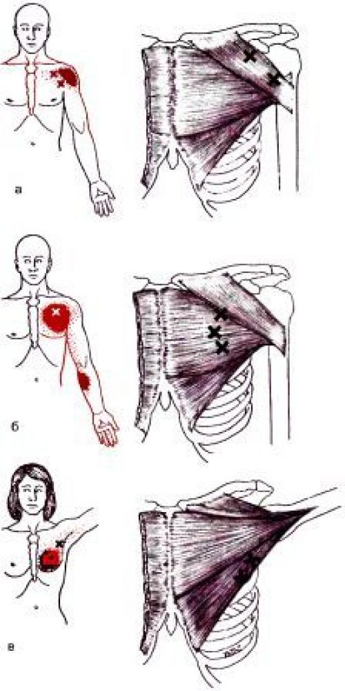 Подостная мышца плеча триггерные точки