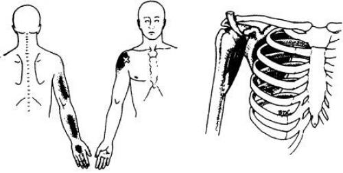Точки на теле человека. Триггерные точки плеча и руки 10