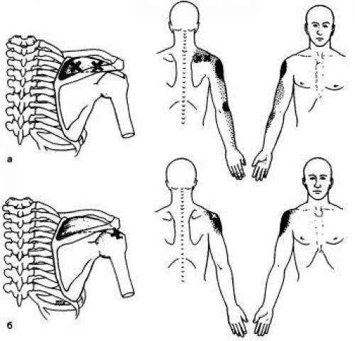 Точки на теле человека. Триггерные точки плеча и руки 09