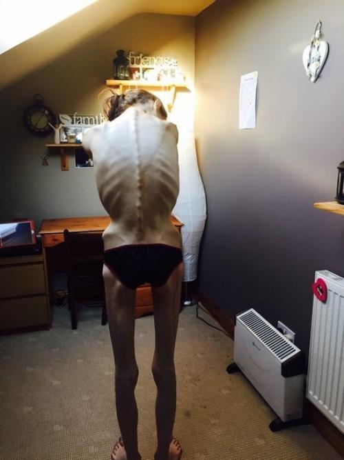 Эта сильная духом красавица поборола анорексию и добилась шикарных результатов! 02