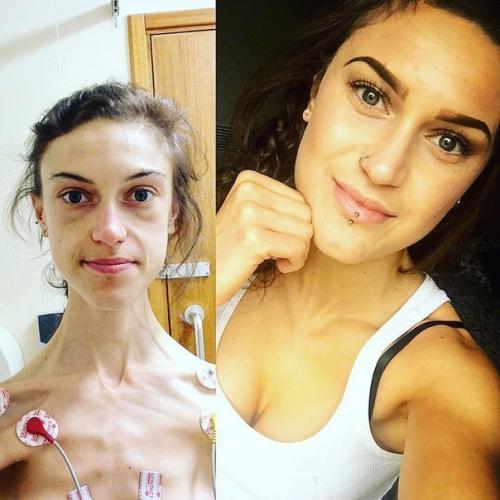 Эта сильная духом красавица поборола анорексию и добилась шикарных результатов! 05