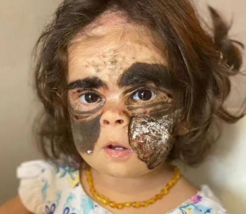 В Краснодаре была проведена уникальная операция по удалению опухоли у двухлетней девочки из Америки, известной как Девочка с Маской Бэтмена. 01