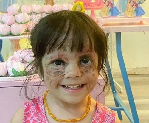 В Краснодаре была проведена уникальная операция по удалению опухоли у двухлетней девочки из Америки, известной как Девочка с Маской Бэтмена. 02