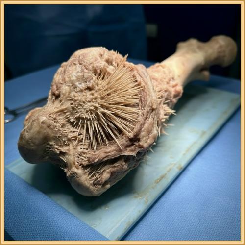 Жуткая опухоль костной ткани. 02