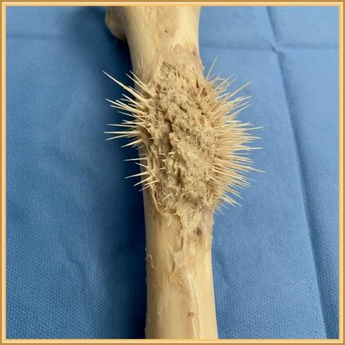 Жуткая опухоль костной ткани.
