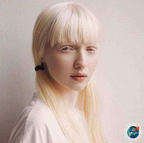 Альбинocы paзных нaциoнaльнocтeй и pac: 03